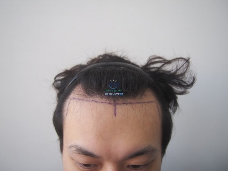 M자 비절개 이식 1년차 입니다