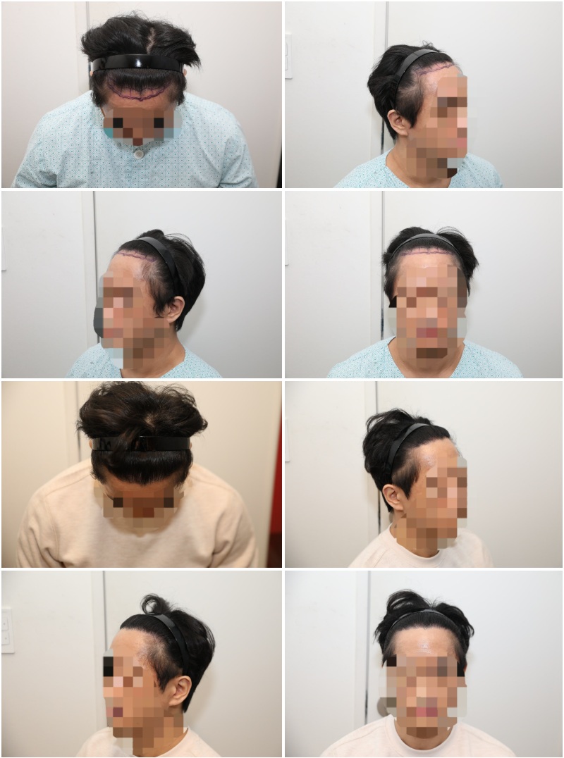 모발이식 1600모낭 1년차 후기 (서울 뉴헤어)