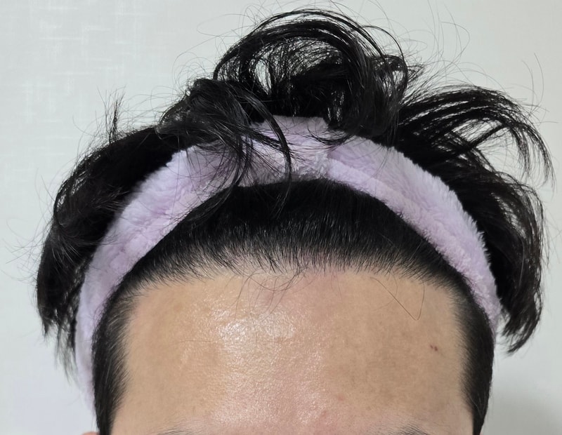 모재성 1400모낭 비절개 후기(8개월 차)