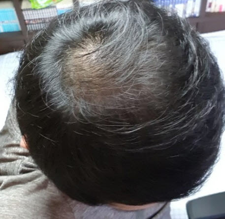 머리사진 수술전.jpg