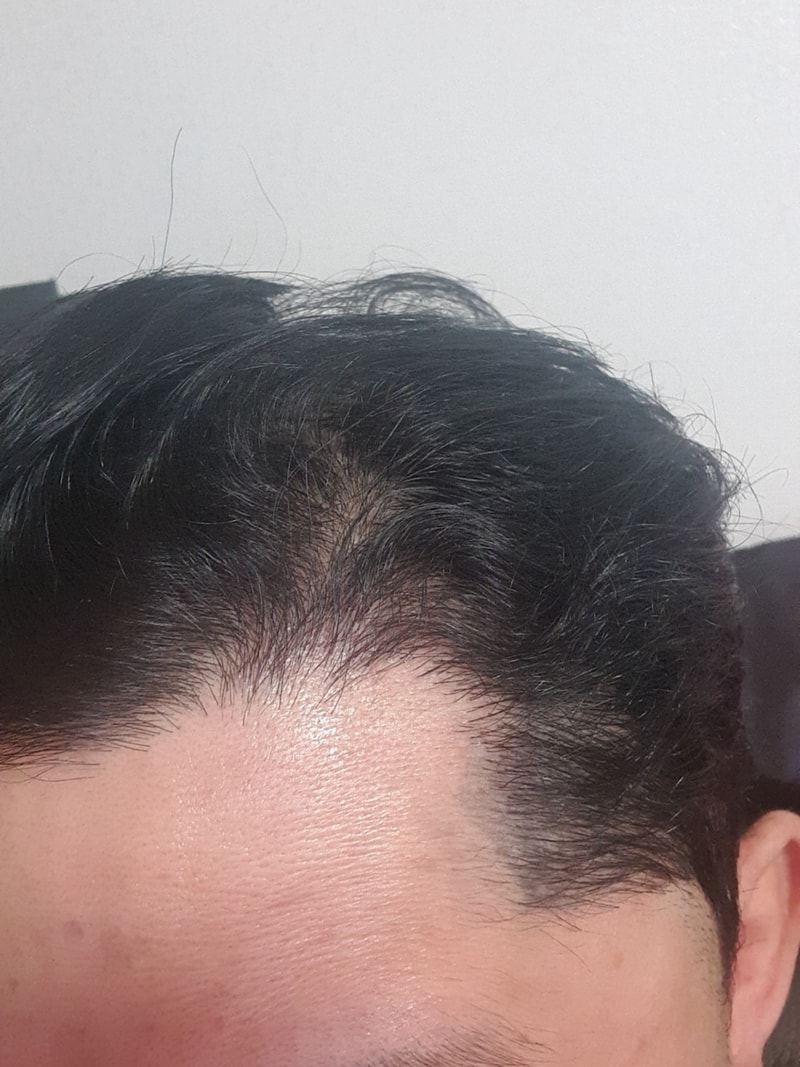 비절개수술 엠자모발이식 7개월