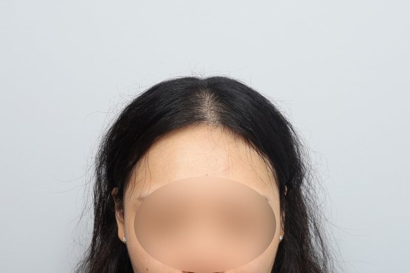 여자 정수리 전두부 무삭발비절개 1500모낭 2주차 모원성형외과