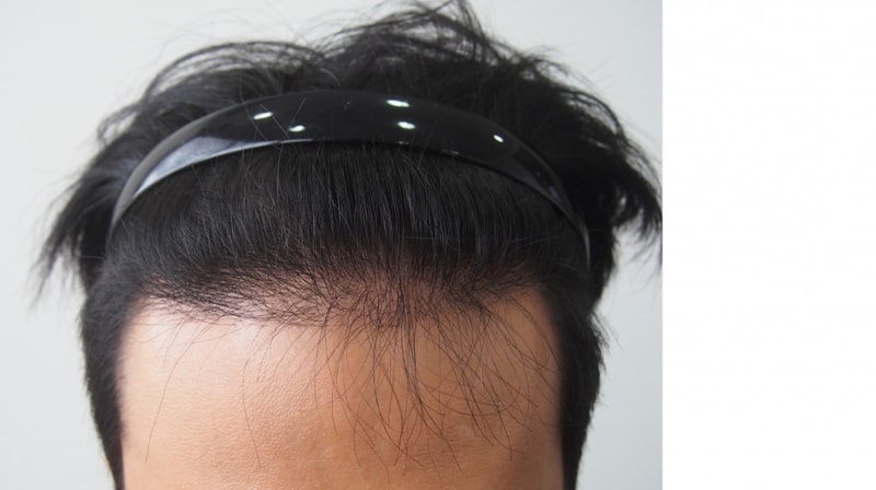 모재성 850모낭 4개월 후기