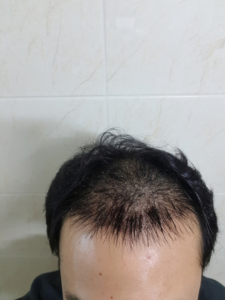 수술3개월차 입니다