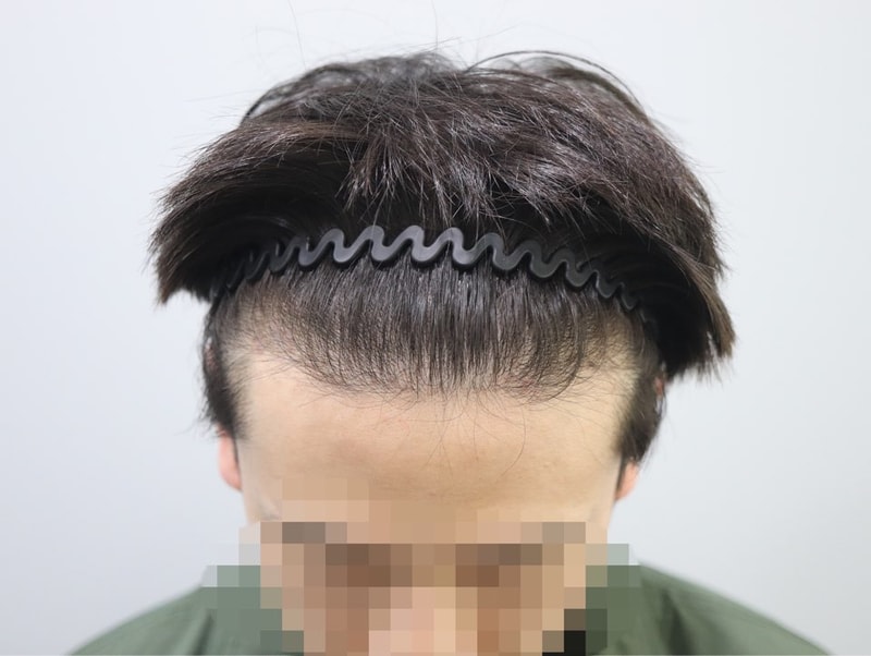 4개월 이마정면.jpg