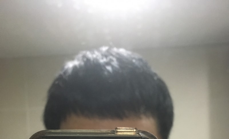 1600모낭 5개월하고 15일차