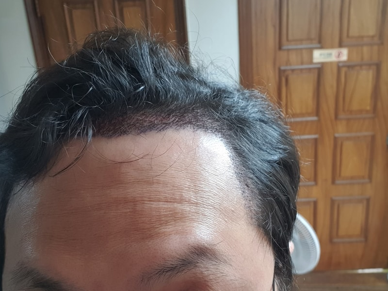 JP성형외과_모발이식_2020_06_04_002.jpg