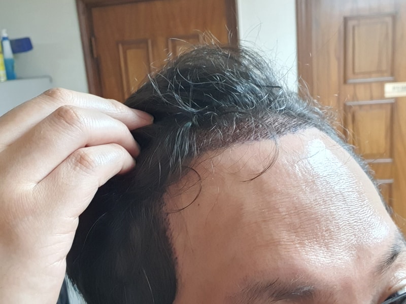 JP성형외과_모발이식_2020_06_04_003.jpg