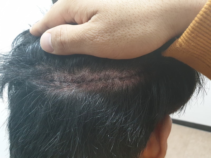 수술10일차 실밥 뽑고 왔어요..ㅎㅎ