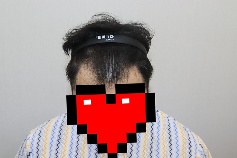 M자탈모 4000모 수술 270일차
