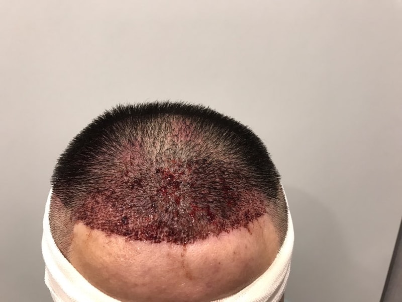 인생 첫 모발이식. 다나에서 했어요