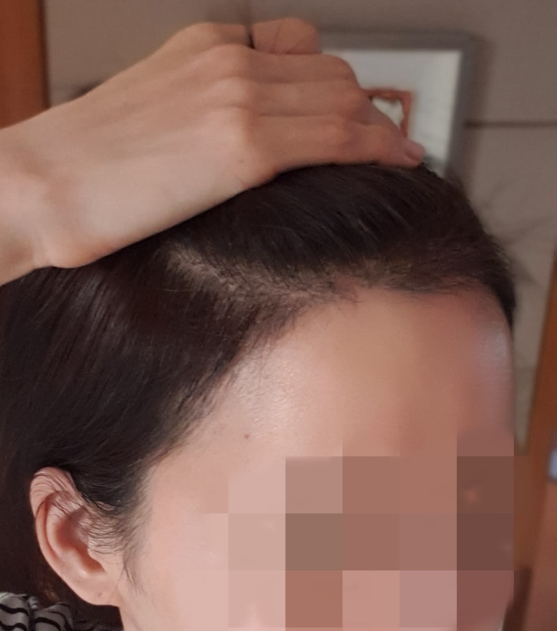 다나 롱헤어비절개 모발이식 168일차