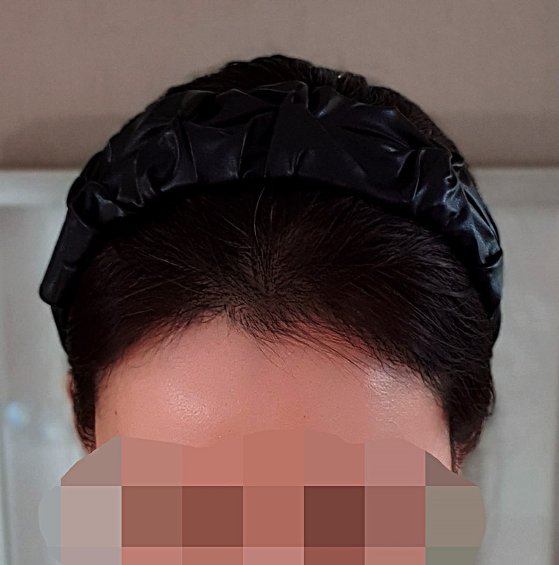 다나 롱헤어모발이식 117일차 (오랜만에 글써요)