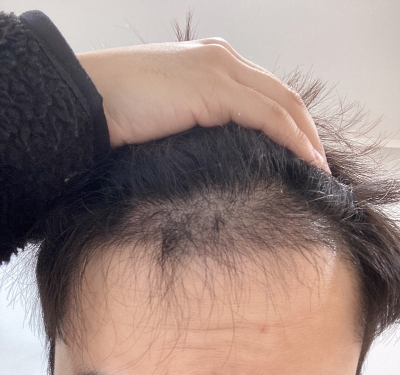 다나 무삭발 모발 이식 3개월. 저는 암흑기가 거의 없어요
