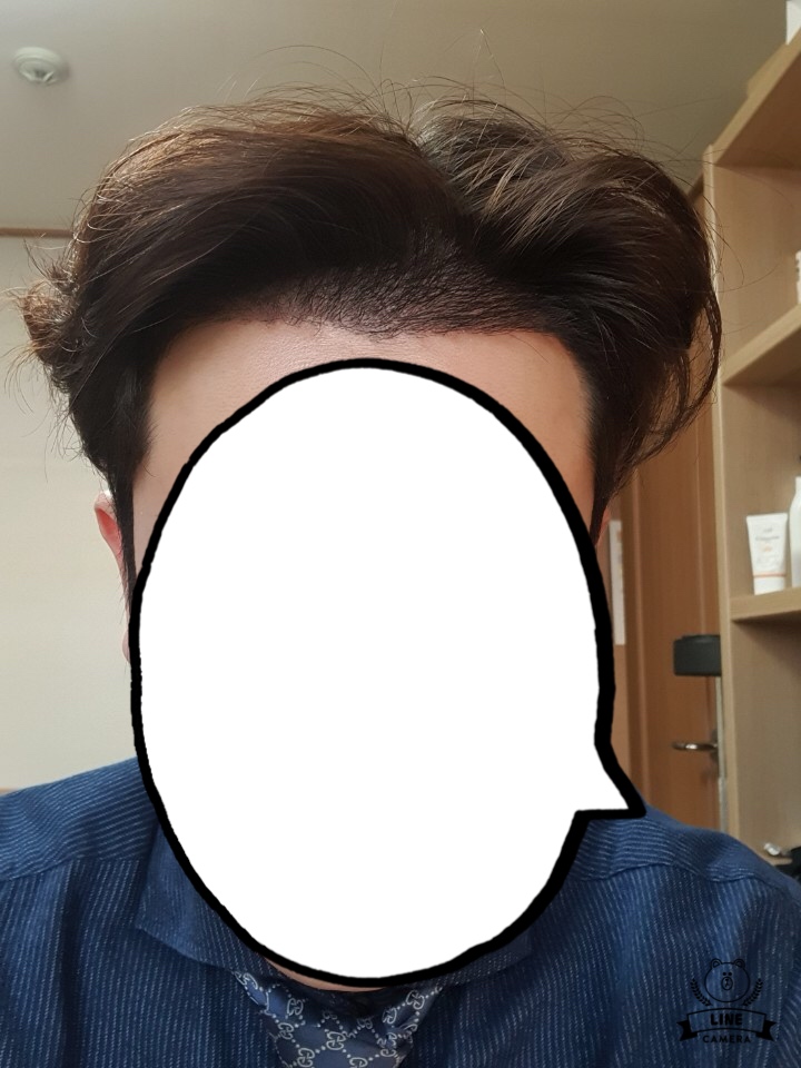 재수술 15일 경과 - 다나 절개 2500모