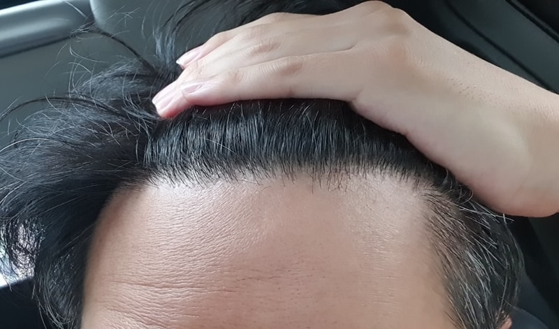 다나에서 비절개 무삭발이식 후 1년8개월 만족 후기