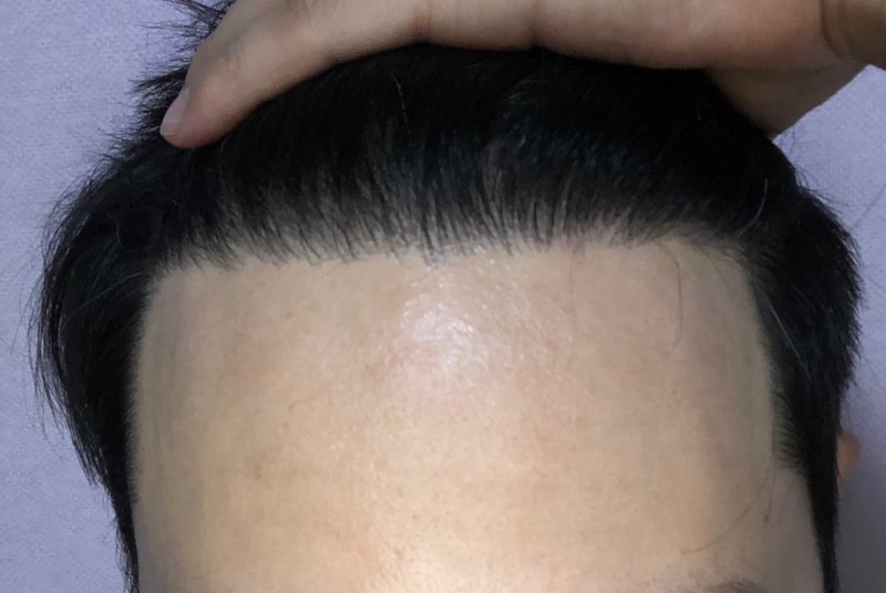 다나 재수술 11개월 ok
