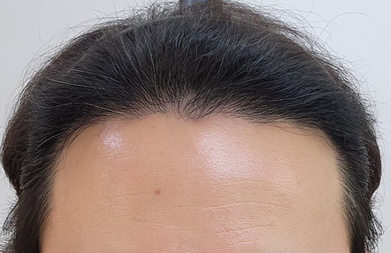 비절개 모발이식 7개월 후기 밀도 괜찮은가요??