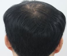 정수리 부분 비절개 슬릿 1000모낭 7개월