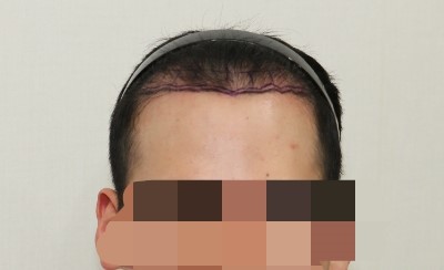 재수술 후, 암흑기 보내고 있습니다. 이번만큼은 꼭 성공하고 싶습니다!