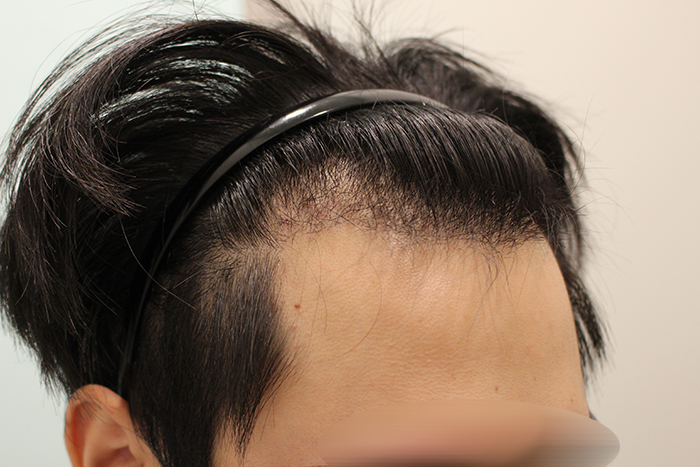수술후 16일 (2).JPG