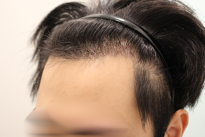 수술후 16일 (14).JPG