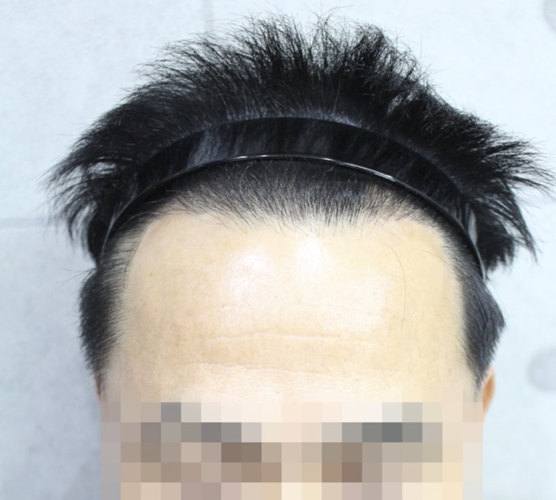 모발이숙후_3.png