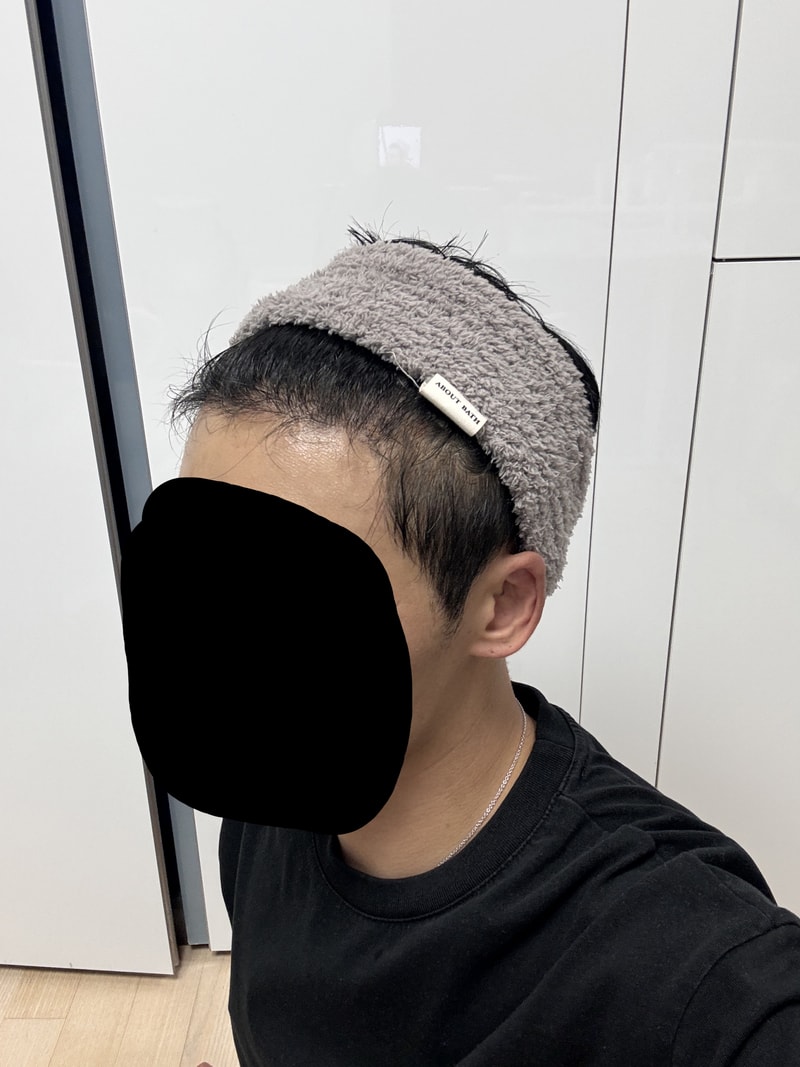 Dark age doesn't mean you're falling out. (1400 follicles@ 4 months)