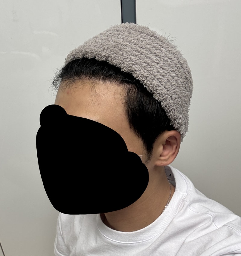 Dana Plastic Surgery Hairline 1400 hair follicles 5 months later (overcoming emza in mid-20s)