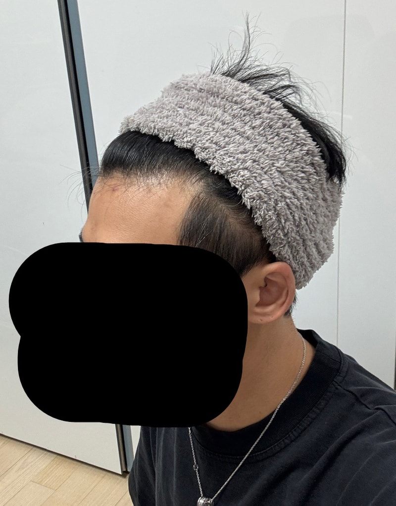 Dana plastic surgery clinic. I planted my hairline on day 2