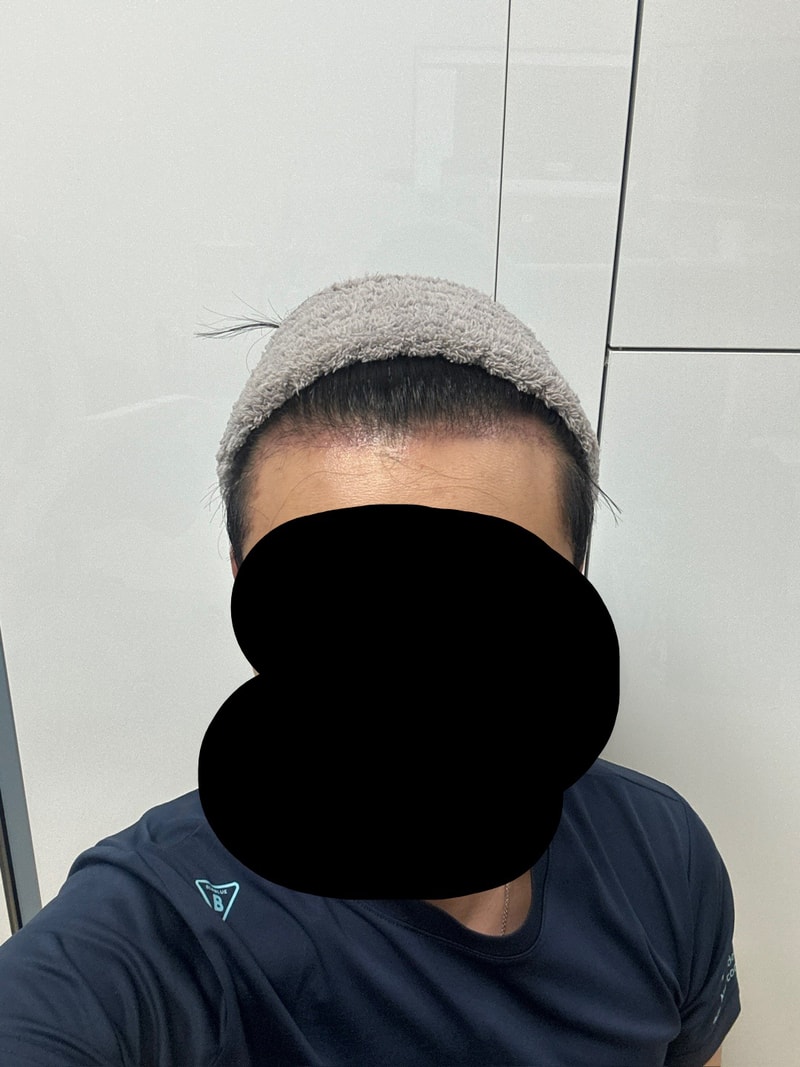 Dana 1400+@One month after hair follicle surgery (share precautions)