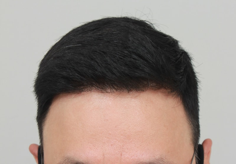 6.수술후.JPG
