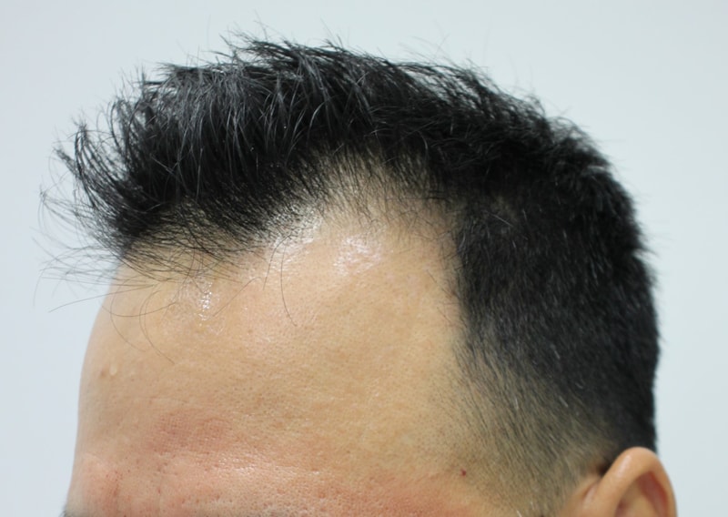7.수술전.JPG