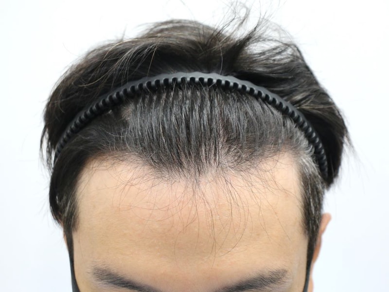 狎鴎亭フォーヘアスリット11ヶ月目の植毛後、より幸せになった私たちの家族
