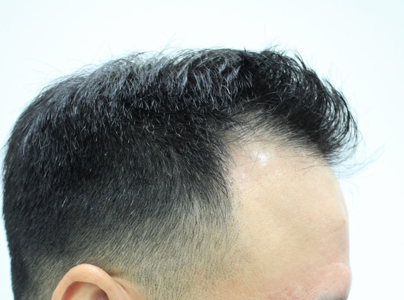9.수술전.JPG