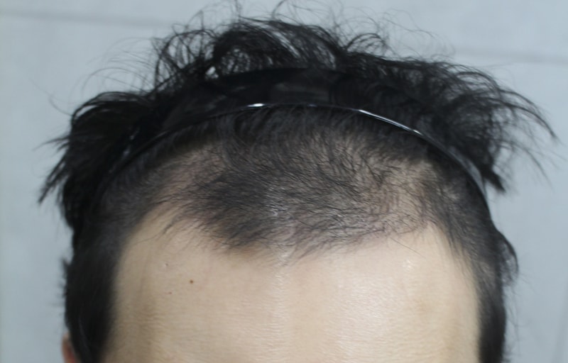 이식을 한지 3개월 되어 사진을 올려봅니다