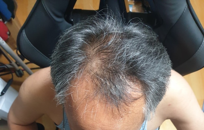 Dana Plastic Surgery Surgery Mass Transplantation 3,200 Hair follicles 1 Year Late