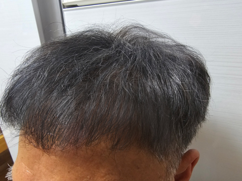 Hair transplant. 23 months. Dana.To the plastic surgery staff.