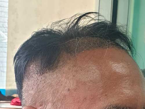 It's been 29 months since Dana Plastic Surgery's mass hair loss transplant 6,400 heads. (Shredding)