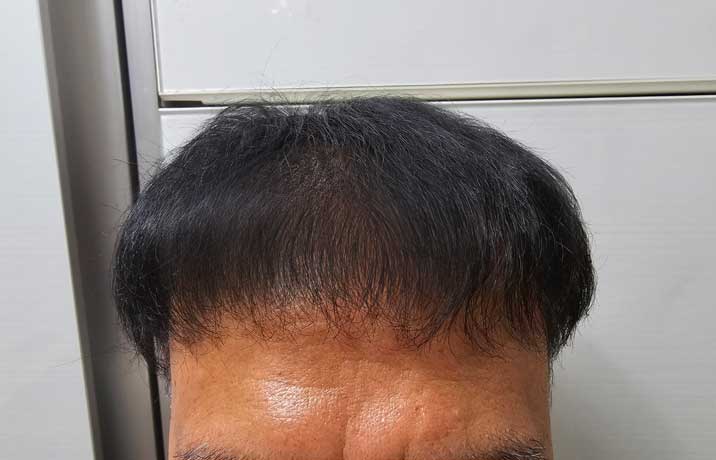 Thanks to Dana Plastic Surgery Director... Successful story for 22 months of mass hair transplant with 6400 hair