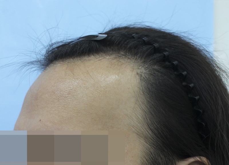 이식전  (2).png