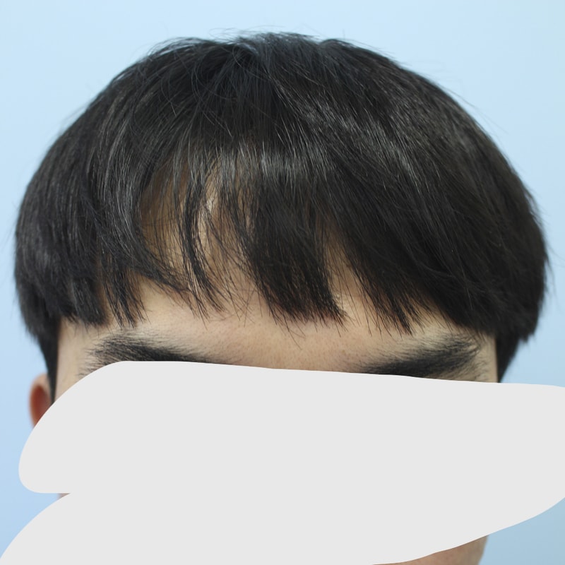 M자 부위와 정수리 이식을 같이 받고 왔어요