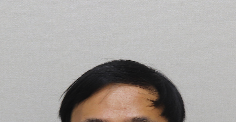 7 수술전 앞머리 평소 스타일.JPG