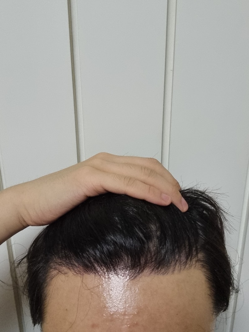 모발이식 곧 1년 다되어가네요 또 후기 올립니다 (3500모 비절개)