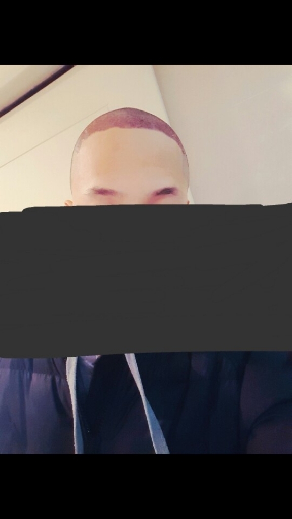 수술 다음날 샴푸직후.jpg