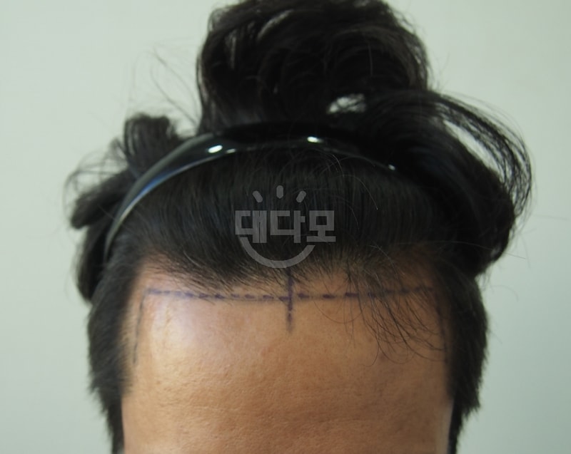 비절개 1200모낭 5개월차 후기입니다.