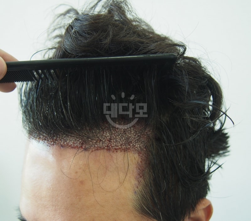 수술후3.JPG