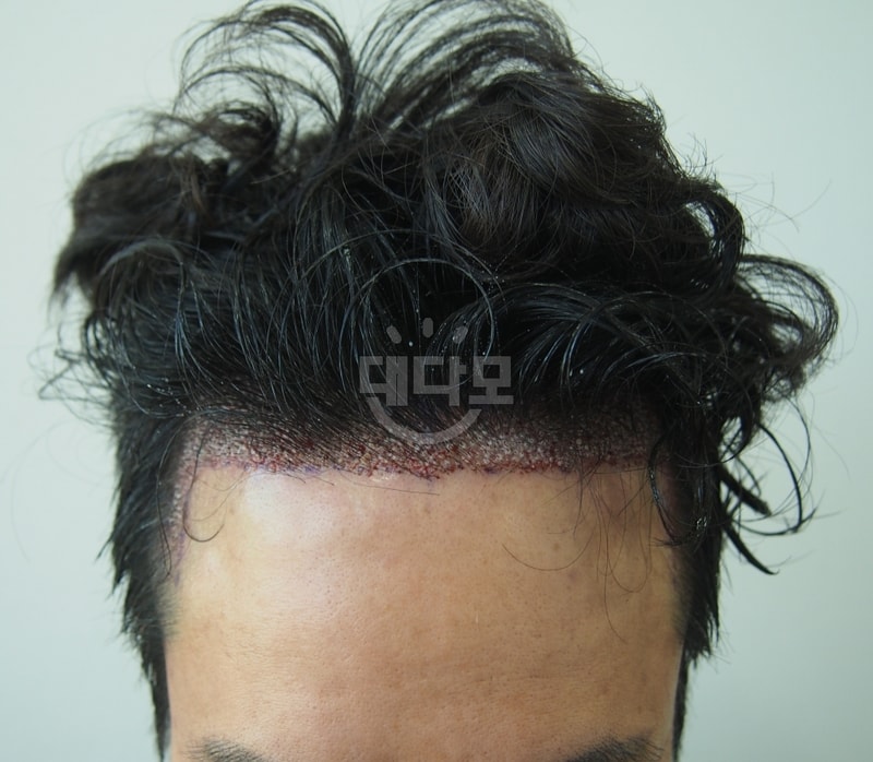 수술후1.JPG