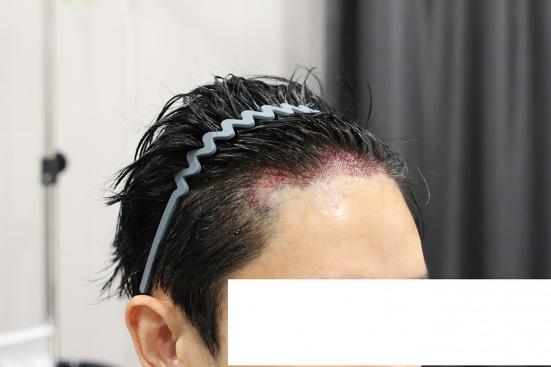수술당일_우측면.jpg