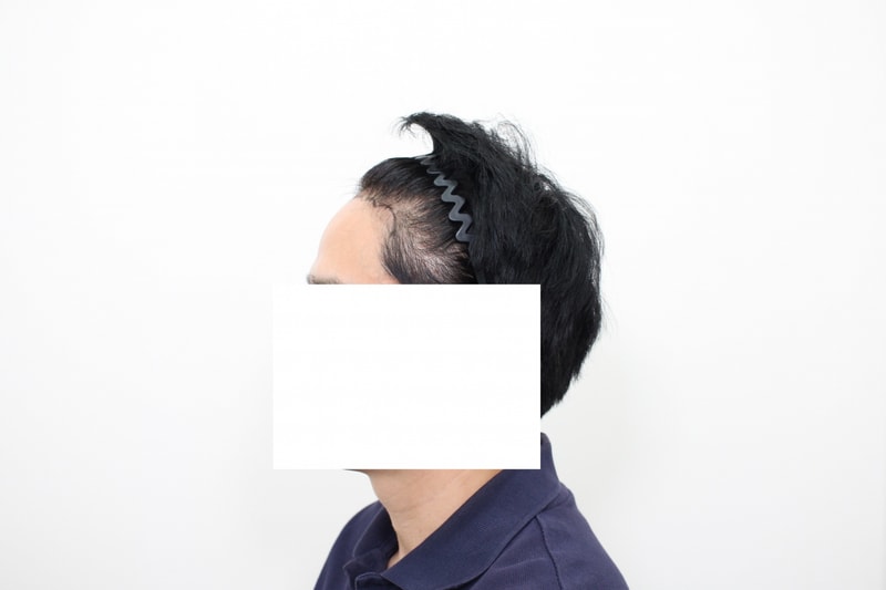 수술전_좌측면.jpg